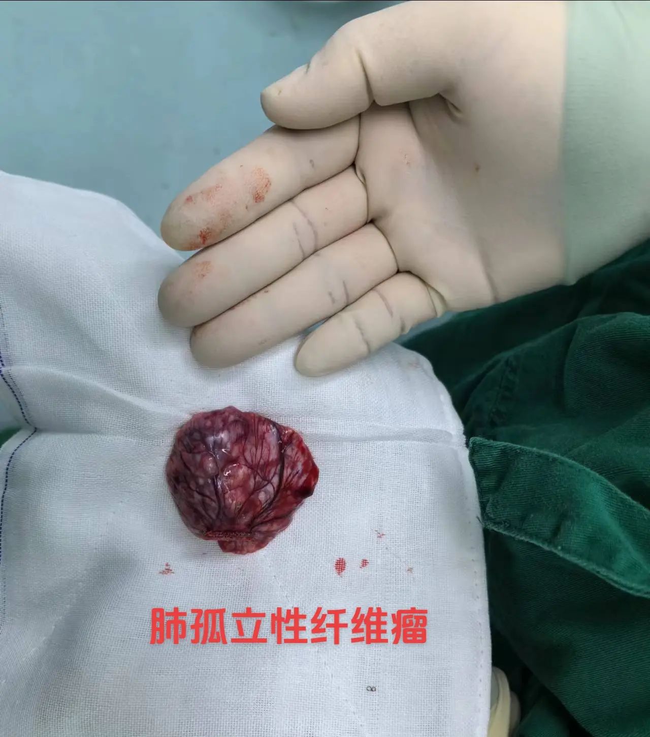 孤立性纤维瘤，solitary fibrous tumor, SFT是发生罕见的，生物学行为不可预测的，相对惰性的，源于成纤维细胞的间叶组织肿瘤